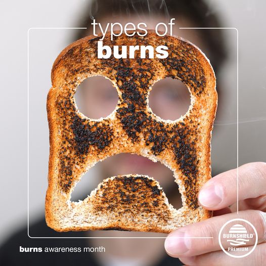 What are the most common types of Burns and how do we treat them?