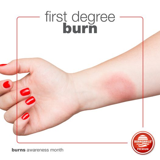 What is the Difference between a Superficial / First-degree burn and a Partial-thickness or second-degree burn?