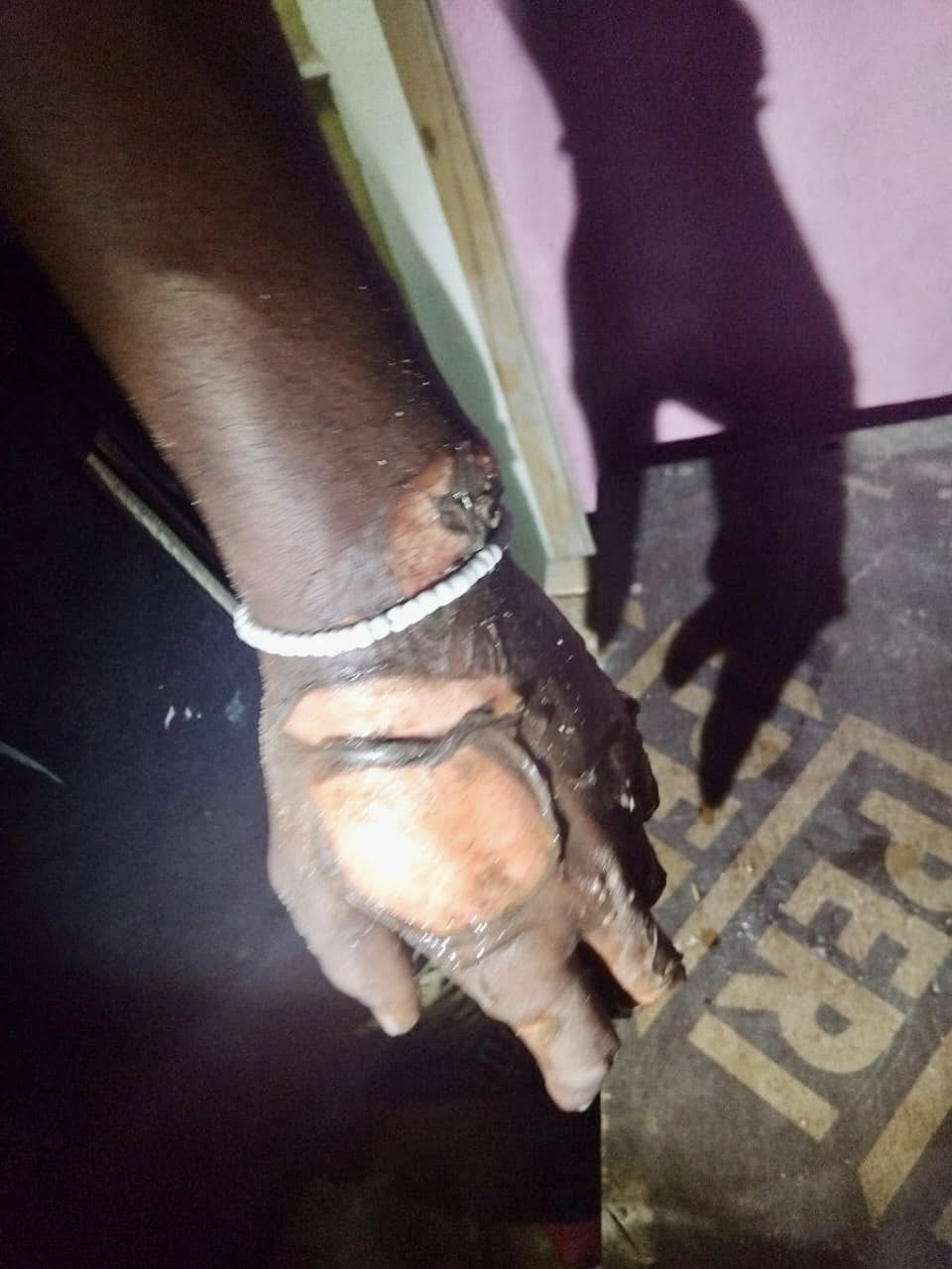 Man Sustained Burns In House Fire: Mtomba - KZN