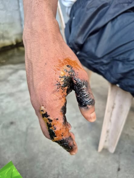 A 24-year-old man sustained injuries following an explosion while burning refuse outside his home