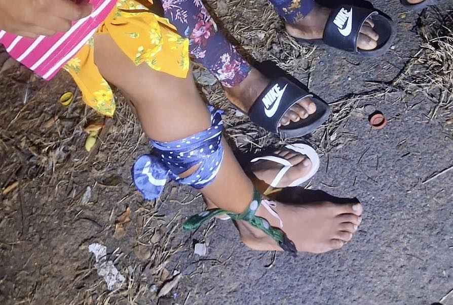 Woman Bitten By Snake Near Outdoor Toilet: Coniston - KZN